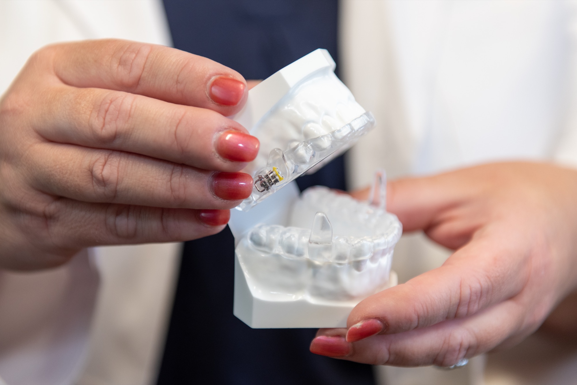 A clear aligner tray and a dental model of the upper teeth held in hand